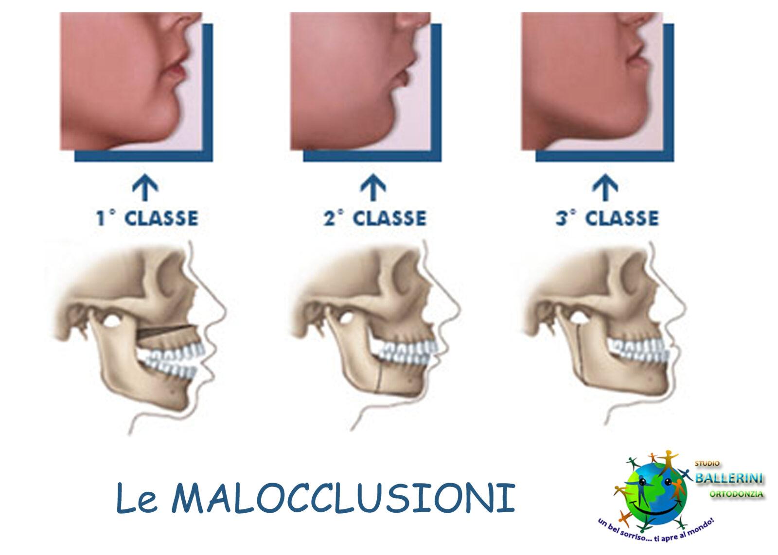 Malocclusioni copia