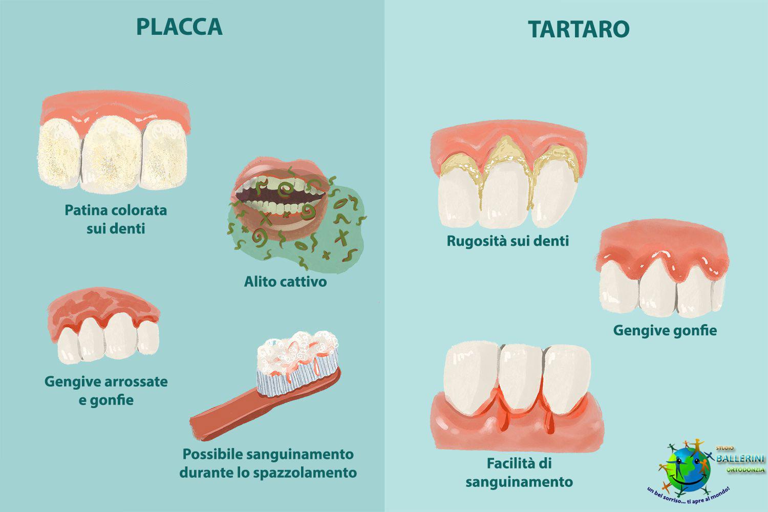 placca tartaro